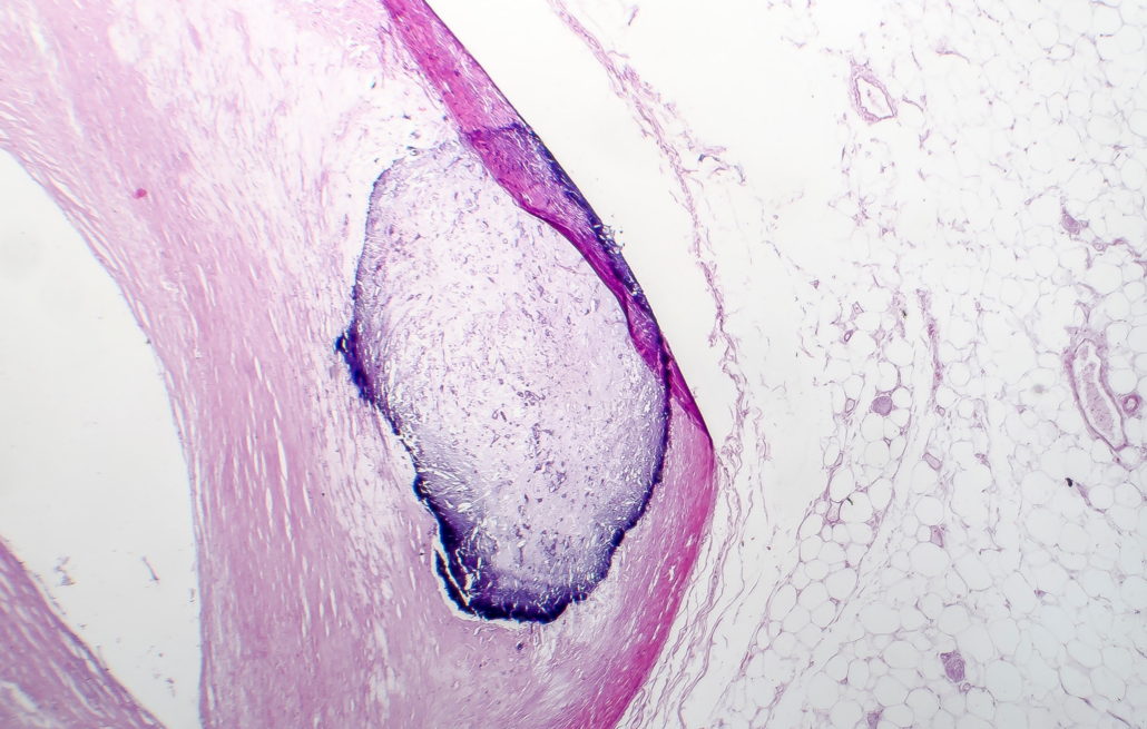 calcification of coronary artery